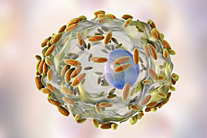 Microscopic diagnosis of bacterial vaginosis. Epithelial cell, so-called clue cell is covered with bacteria Gardnerella photo