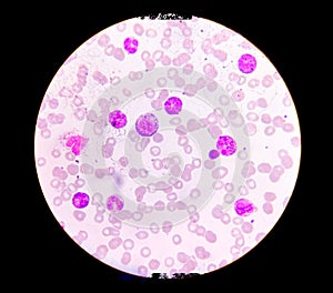 Microscopic examination of blasts or leukemia cells in blood smear of human.