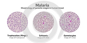 Microscopic examination of blood films from malaria infected pat