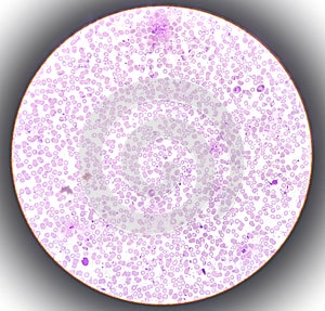 Microscopic finding, Neutrophilic leukocytosis with thrombocytosis. photo