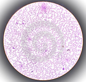 Microscopic finding, Neutrophilic leukocytosis with thrombocytosis. photo