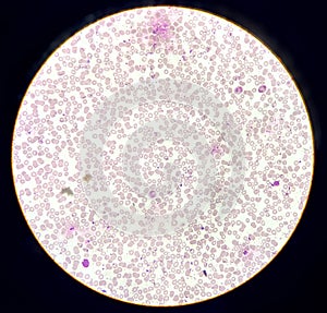 Microscopic finding, Neutrophilic leukocytosis with thrombocytosis. photo