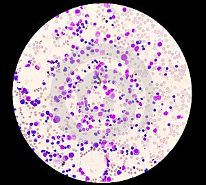 Microscopic image of blood cancer bone marrow study
