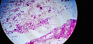 Microscopic image of a cytology of a non-small cell lung tumor. Medical themes