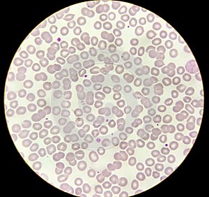 Microscopic image of macrocytic anaemia with thrombocytopenia.