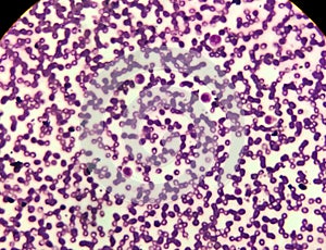 Microscopic image of macrocytic anaemia with thrombocytopenia, folic acid deficiency, photo