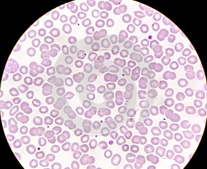 Microscopic image of macrocytic anaemia with thrombocytopenia. photo