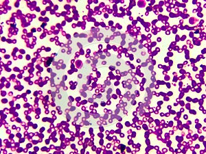 Microscopic image of macrocytic anaemia with thrombocytopenia, folic acid deficiency, photo