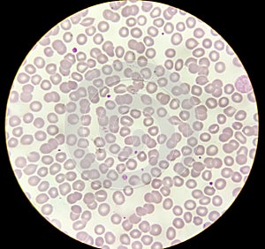 Microscopic image of macrocytic anaemia with thrombocytopenia. photo