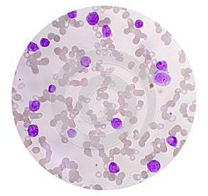 Microscopic image showing Chronic myeloid leukaemia (CML) is a type of cancer