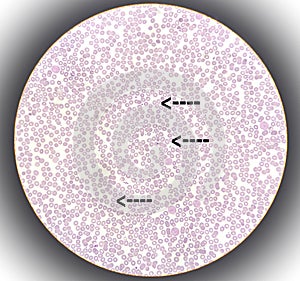 Microscopic show zooming image of hereditary haemolytic anemia.