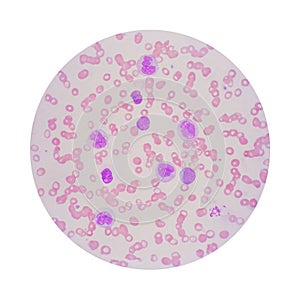 Microscopic view of a blood smear from leukemia patient showing