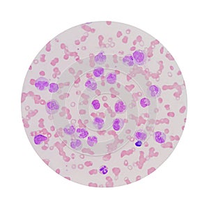 Microscopic view of a blood smear from leukemia patient showing