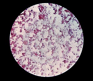 Microscopic view of CT guided fine needle aspiration cytology (FNAC) of a patient. Carcinoma