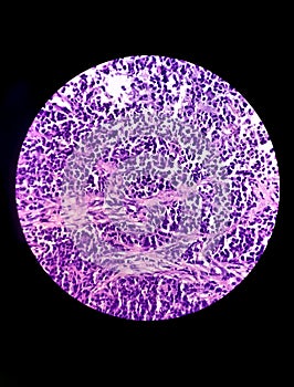 Microscopic view of stained slide of Histology. A Slide of malignancy. Biopsy. Cancer.