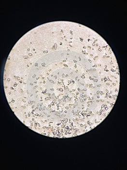 Microscopic view of struvite crystals from urinary sediment. Magnesium ammonium phospate crystals. Causing Feline Lower Urinary