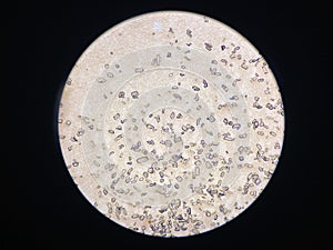 Microscopic view of struvite crystals from urinary sediment. Magnesium ammonium phospate crystals. Causing Feline Lower Urinary