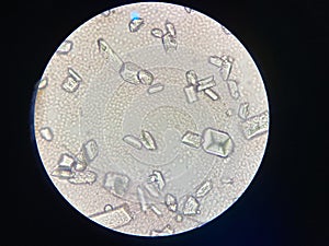 Microscopic view of struvite crystals from urinary sediment. Magnesium ammonium phospate crystals. Causing Feline Lower Urinary