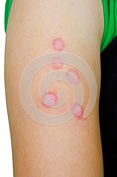 Microsporia a fungus on skin of arm.