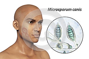 Microsporum canis fungal infection, 3D illustration