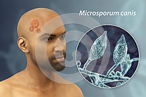 Microsporum canis fungal infection, 3D illustration