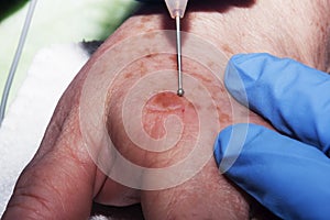 Microsurgery: Removing skin diseases