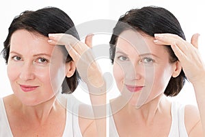 Middle age close up forehead woman happy face before after cosmetic procedures. Skin care for wrinkled face. Before-after anti-