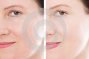 Middle age close up woman happy face before after cosmetic procedures. Skin care for wrinkled face. Before-after anti-aging