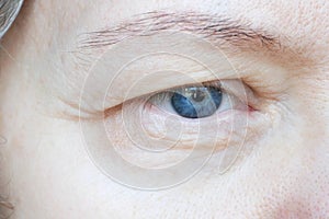 Middle aged female`s eye with drooping eyelid. Ptosis is a drooping of the upper eyelid, lazy eye. Cosmetology and facial concept