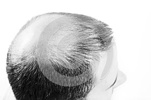 Middle-aged man concerned by hair loss Baldness alopecia Black and white