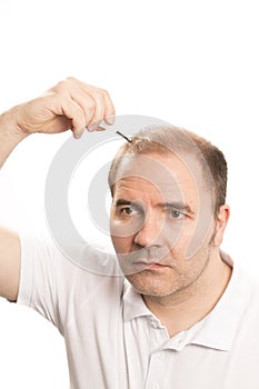 Middle-aged man concerned by hair loss Baldness alopecia Black and white