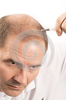 Middle-aged man concerned by hair loss Baldness alopecia Black and white