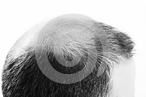 Middle-aged man concerned by hair loss Baldness alopecia Black and white