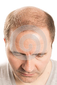 Middle-aged man concerned by hair loss Baldness alopecia Black and white