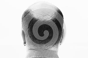 Middle-aged man concerned by hair loss Baldness alopecia close up black and white, white background