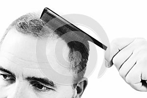 Middle-aged man concerned by hair loss Baldness alopecia close up black and white, white background