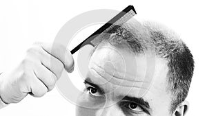 Middle-aged man concerned by hair loss Baldness alopecia close up black and white, white background