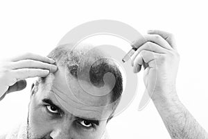 Middle-aged man concerned by hair loss Baldness alopecia close up black and white, white background