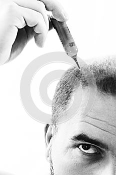 Middle-aged man concerned by hair loss Baldness alopecia close up black and white, white background