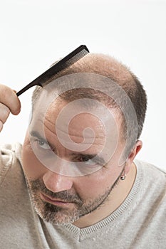 Middle-aged man concerned by hair loss Baldness alopecia close up white background