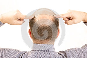 Middle-aged man concerned by hair loss Baldness alopecia close up white background