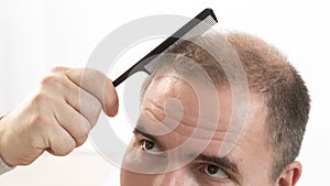 Middle-aged man concerned by hair loss Baldness alopecia close up white background