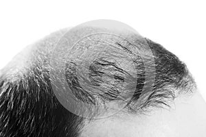 Middle-aged man concerned by hair loss Baldness alopecia isolated