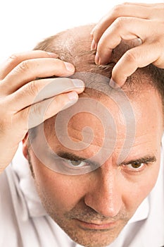 Middle-aged man concerned by hair loss Baldness alopecia isolated