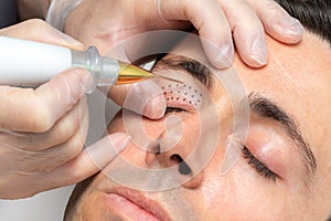 Middle aged man having laser plasma pen therapy on eyelids