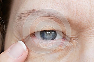 Middle-aged woman does corrective eye makeup to correct the drooping eyelid. Ptosis is a drooping of the upper eyelid, lazy eye.