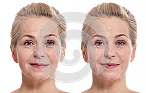 Middle aged woman face before and after cosmetic procedure. Plastic surgery concept.