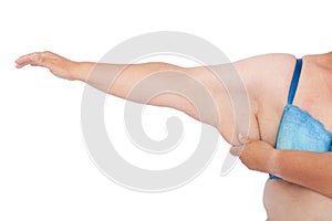 Middle aged woman with sagging excess arm skin after extreme weight loss. Front view full right arm holding excess skin