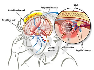 Migraine photo