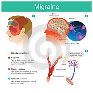 Migraine. Headache, pain, tend cooccur on one side of the headP photo